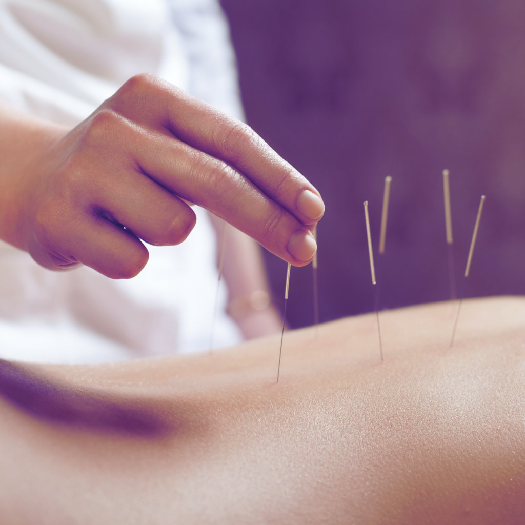 TCM Acupuncture